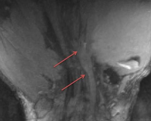 Figure 3 for case Neuroma in continuity